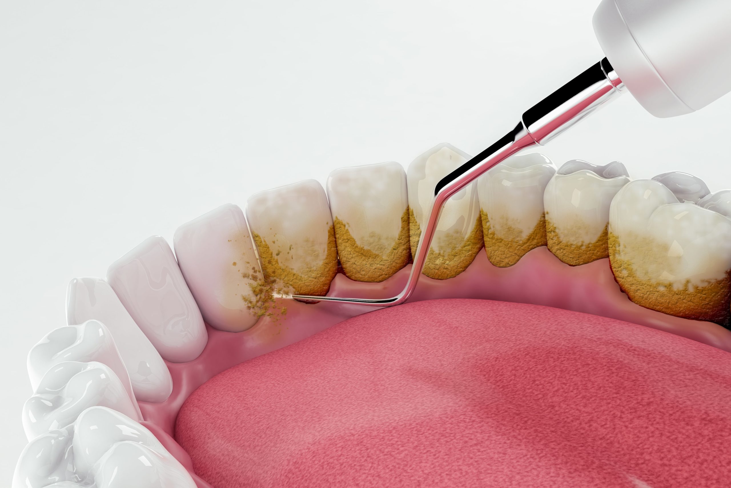 Dental Hygiene - Kensington Court Clinic - Sub Header Image - removing plaque