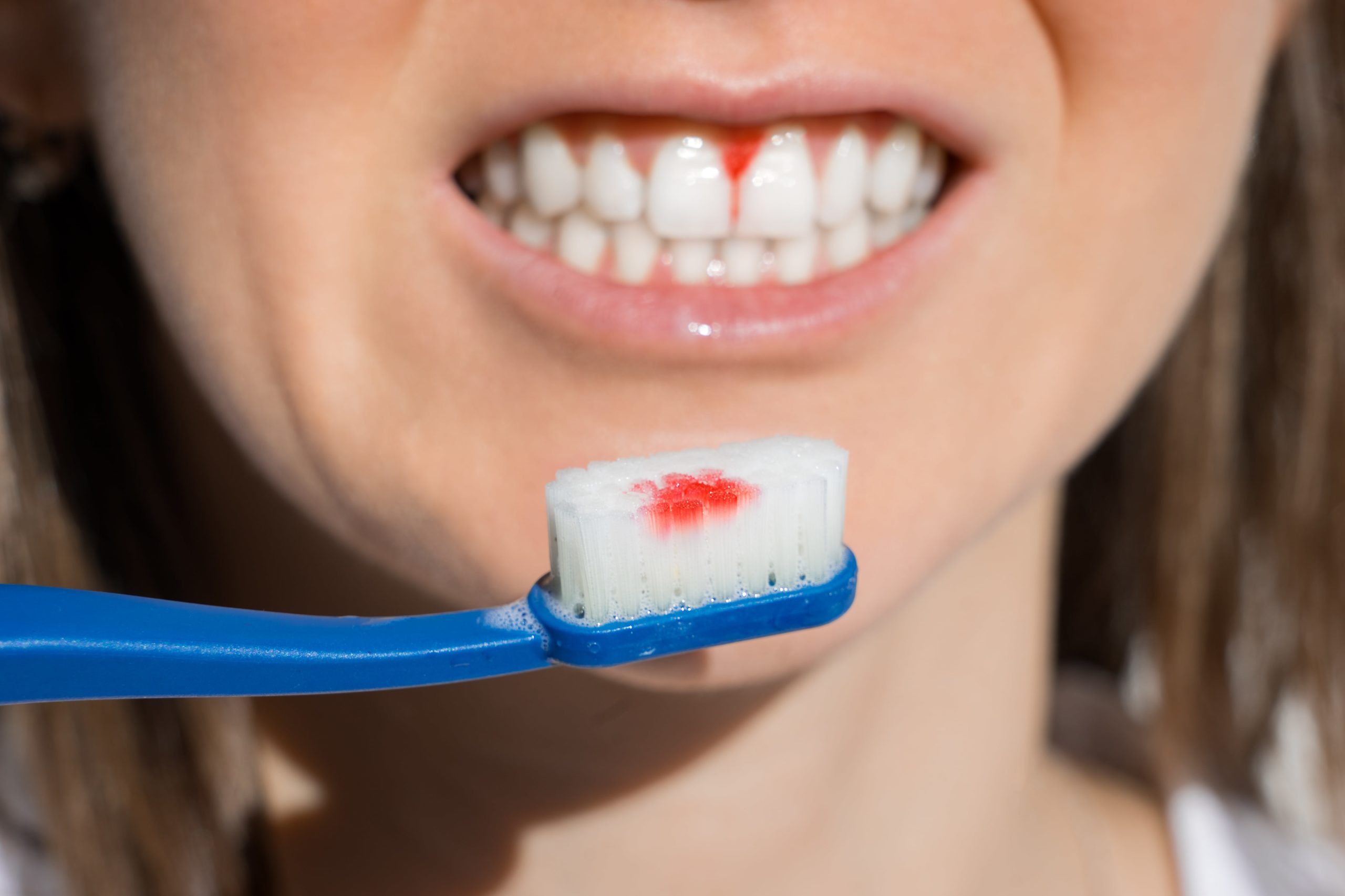 Dental Hygiene - Kensington Court Clinic - why you should remove plaque -bleeding gums